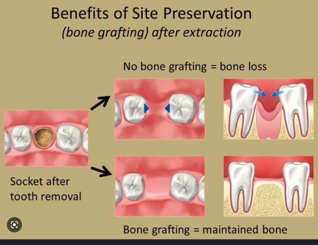 The image shows a diagrammatic illustration of a dental extraction process, highlighting the benefits of site preservation in bone grafting after tooth removal, with annotations explaining the steps involved.